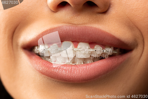 Image of Beautiful young woman with teeth braces