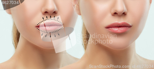 Image of Before and after lips filler injections. Beauty plastic. Beautiful perfect lips with natural makeup.
