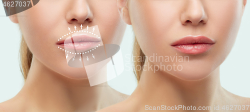 Image of Before and after lips filler injections. Beauty plastic. Beautiful perfect lips with natural makeup.