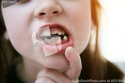 Image of little girl without tooth smiling