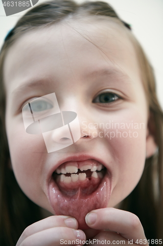 Image of little girl without tooth smiling