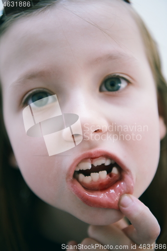 Image of little girl without tooth smiling