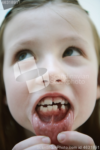 Image of little girl without tooth smiling