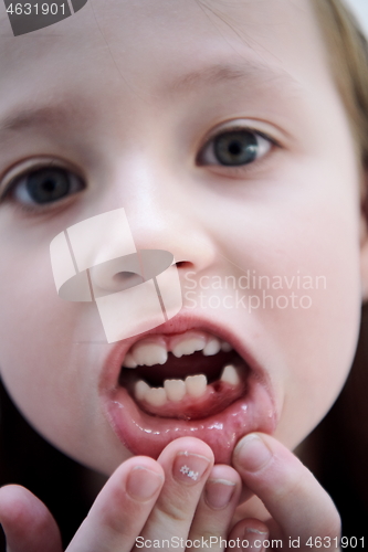 Image of little girl without tooth smiling