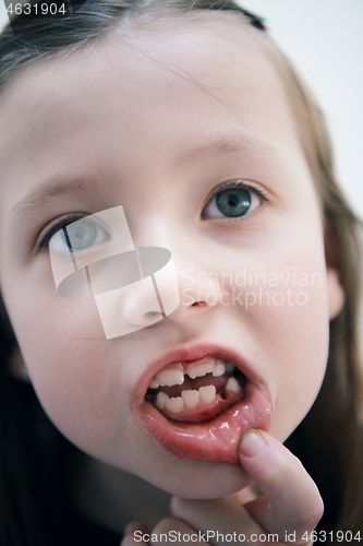 Image of little girl without tooth smiling