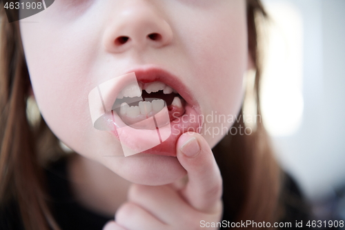 Image of little girl without tooth smiling