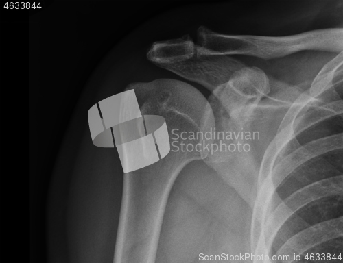 Image of X-ray shoulder radiograph show state of injury