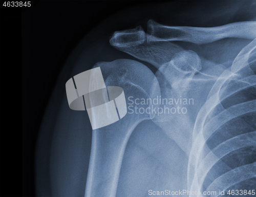 Image of X-ray shoulder radiograph show state of injury