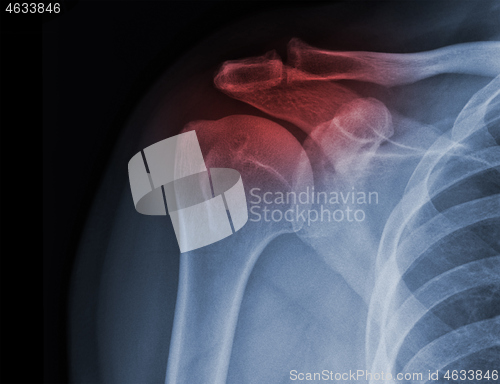 Image of X-ray shoulder radiograph show state of injury