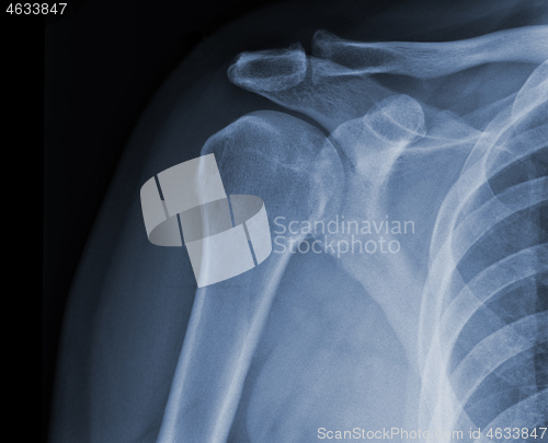 Image of X-ray shoulder radiograph show state of injury