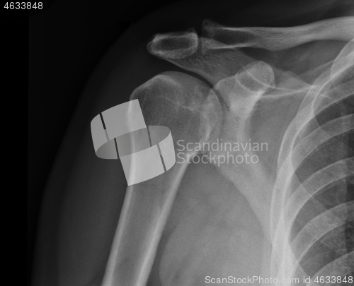 Image of X-ray shoulder radiograph show state of injury
