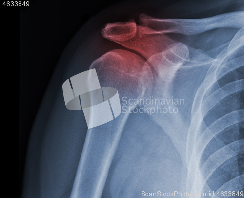 Image of X-ray shoulder radiograph show state of injury