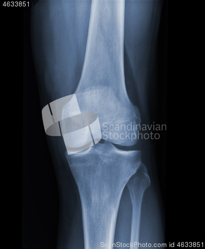 Image of X-ray knee radiograph show state of injury