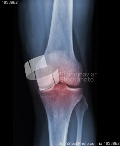 Image of X-ray knee radiograph show state of injury