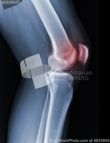 Image of X-ray knee radiograph show state of injury