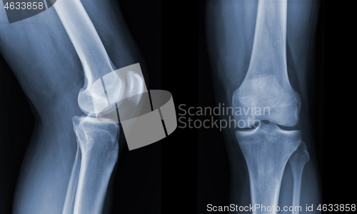 Image of X-ray knee radiograph show state of injury