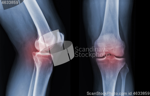 Image of X-ray knee radiograph show state of injury