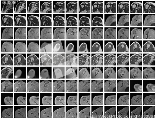 Image of Complete Magnetic resonance of right Shoulder Joint