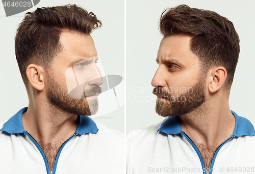 Image of The male face before and after cosmetic nose surgery. Over white background.