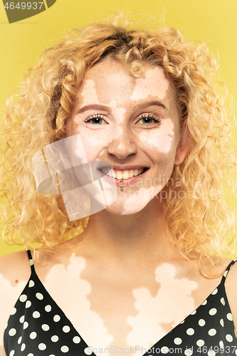 Image of Studio portrait of caucasian woman with vitiligo skin, beauty concept