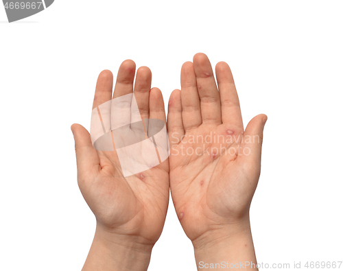 Image of Children hands with chickenpox