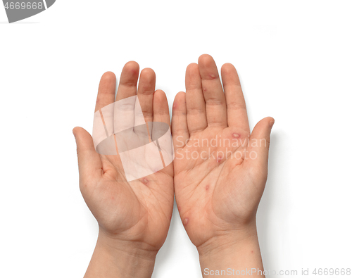 Image of Children hands with chickenpox