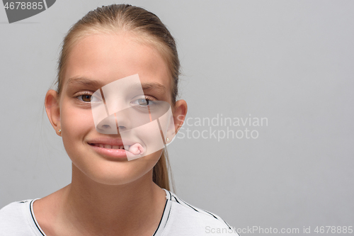 Image of Portrait of a ten-year-old girl with a tampon that sticks out of her mouth after tooth extraction