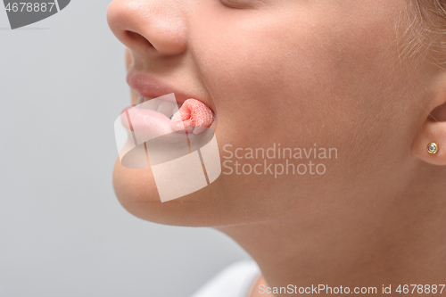 Image of A bloody swab sticks out of the mouth of a ten-year-old girl after tooth extraction, close-up