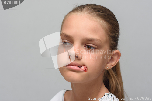 Image of A bloody swab sticks out of the mouth of a ten-year-old girl after tooth extraction