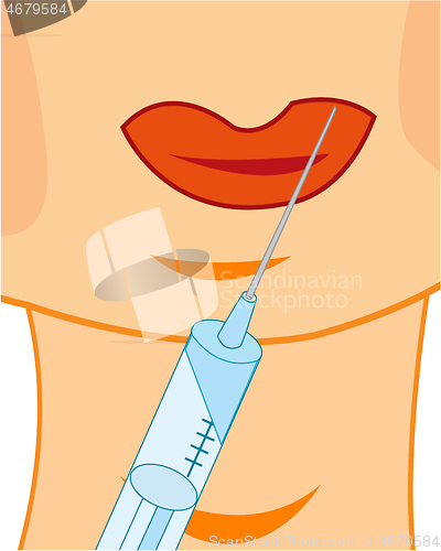 Image of Increase the lips by means of botox procedure