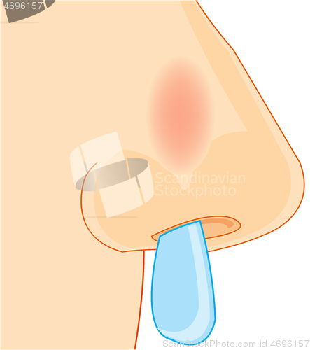 Image of Vector illustration of the nose of the person sick with a cold