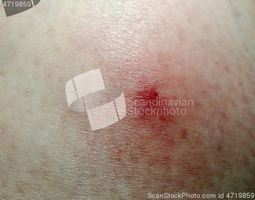 Image of tick bite marks on the skin