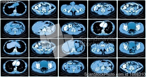 Image of Many computer tomography scans in motion of lower and middle abdominal area