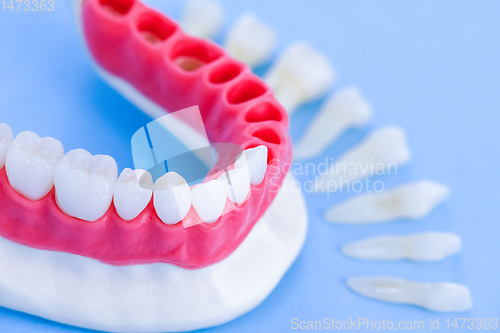 Image of Tooth implant and crown installation process