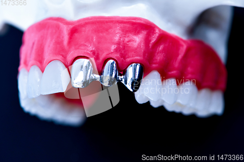 Image of Tooth implant and crown installation process