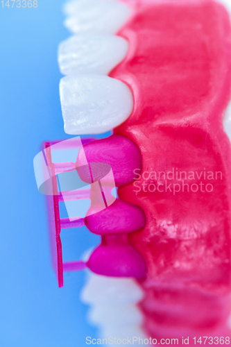 Image of Tooth implant and crown installation process