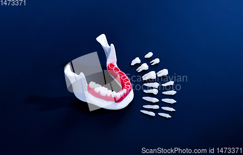 Image of Tooth implant and crown installation process