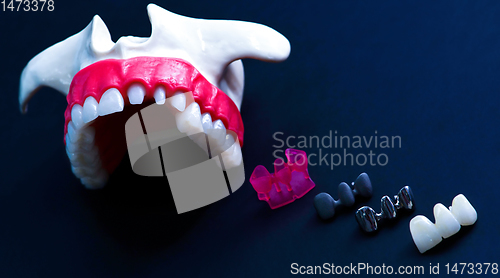 Image of Tooth implant and crown installation process