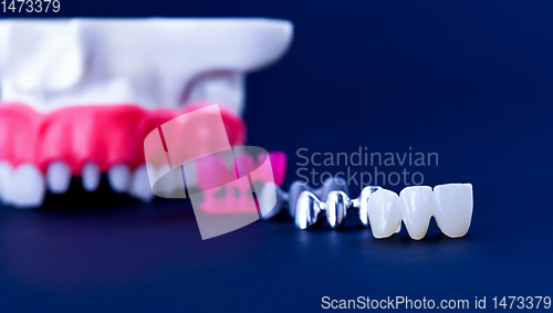 Image of Tooth implant and crown installation process