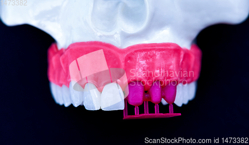 Image of Tooth implant and crown installation process