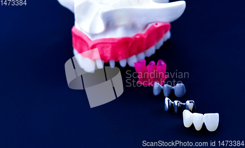 Image of Tooth implant and crown installation process