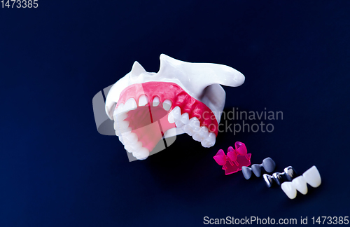 Image of Tooth implant and crown installation process