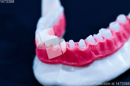 Image of Tooth implant and crown installation process