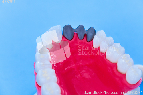 Image of Tooth implant and crown installation process