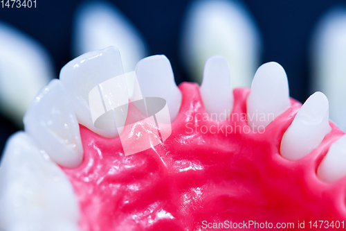 Image of Tooth implant and crown installation process