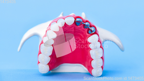 Image of Tooth implant and crown installation process