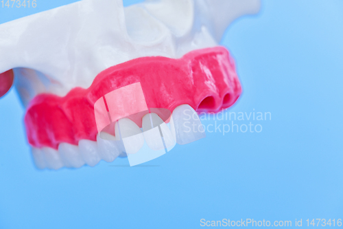 Image of Tooth implant and crown installation process