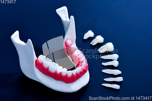 Image of Tooth implant and crown installation process