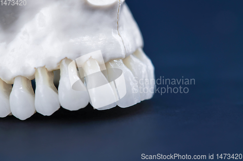 Image of Upper human jaw with teeth