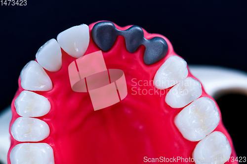 Image of Tooth implant and crown installation process